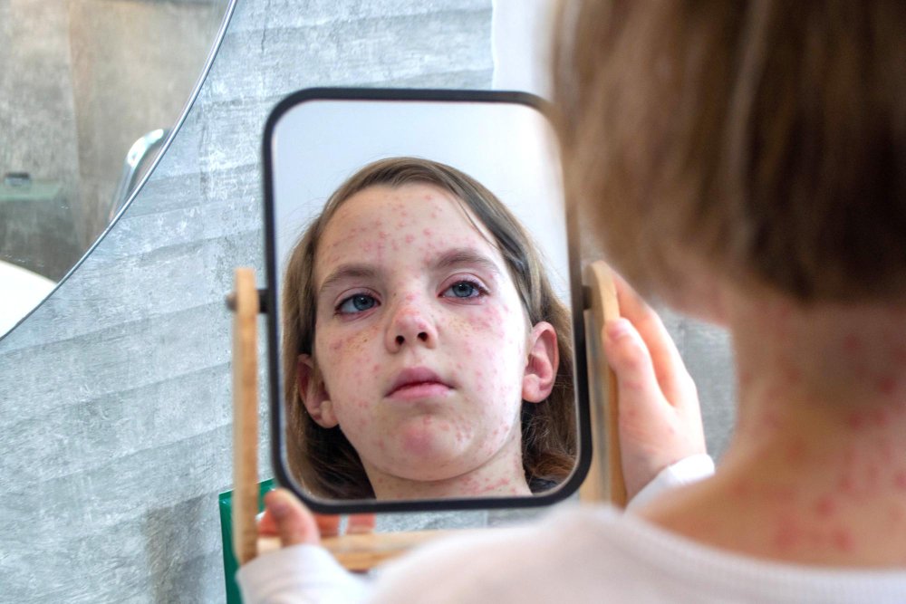 Teen Acne